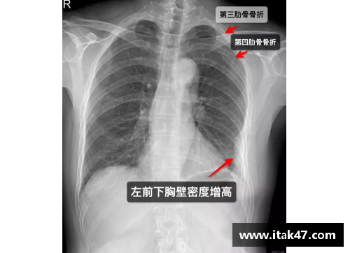 球员肋骨骨折：运动场上的隐形伤痛